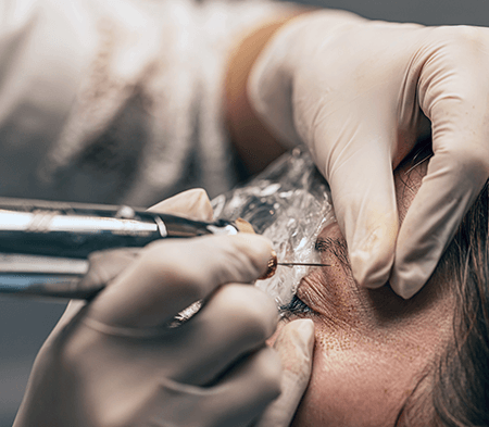 Plasma Pen - Fibroblast Treatment for Skin Tightening in Boca Raton